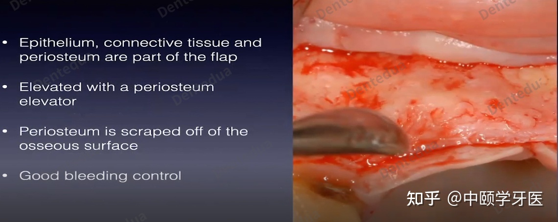 牙周手术中的暗语和翻瓣设想—宾夕法尼亚大学Rodrigo ...-4.jpg