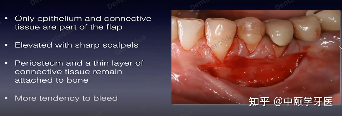 牙周手术中的暗语和翻瓣设想—宾夕法尼亚大学Rodrigo ...-9.jpg