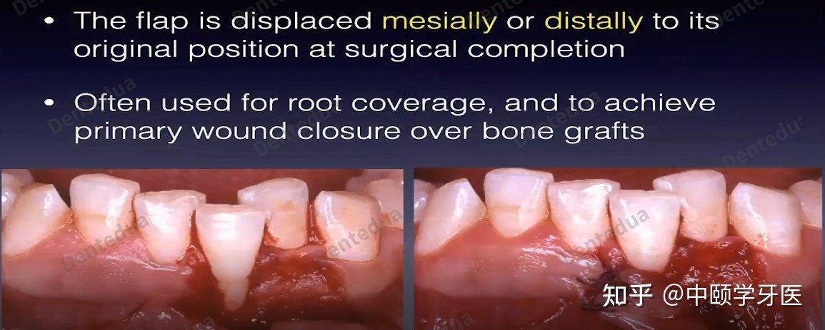 牙周手术中的暗语和翻瓣设想—宾夕法尼亚大学Rodrigo ...-17.jpg